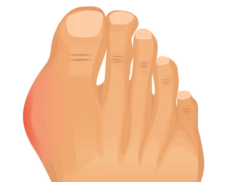 Gout Illustration. First Metatarsophalangeal Joint Arthritis Vector