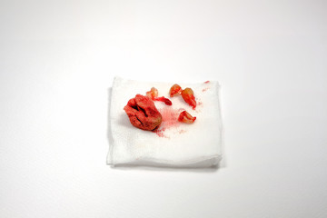 Extraction of decayed tooth with bloody gauze pad on white background. (Dental treatment)