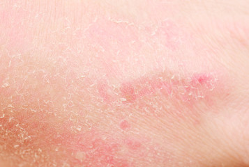Fototapeta premium sunburn