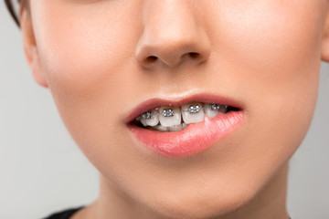 Fototapeta premium Beautiful young woman with teeth braces