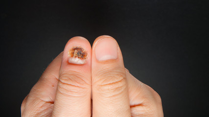 Healthy and ill fingers on black background