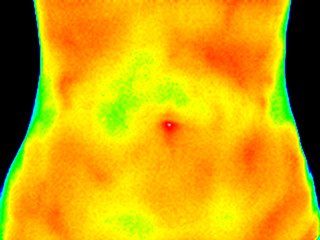 Thermographic image of the abdomen of a woman with the photo showing different temperature in a range of colors from blue showing cold to red showing hot which can indicate inflammation.