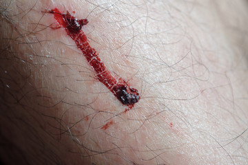Dry blood / Closeup of wound and dry blood on leg.