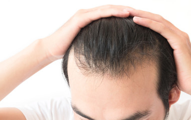 Young man serious hair loss problem for health care shampoo and beauty product concept