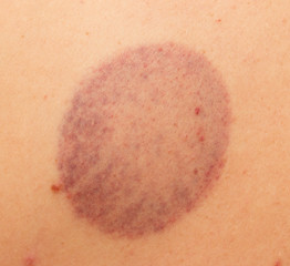 Fototapeta premium bruises on the skin of the back