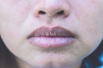 Closeup asian woman face with brittle and dry lips