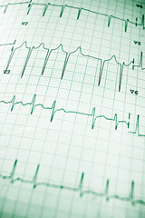 Electrocardiogram
