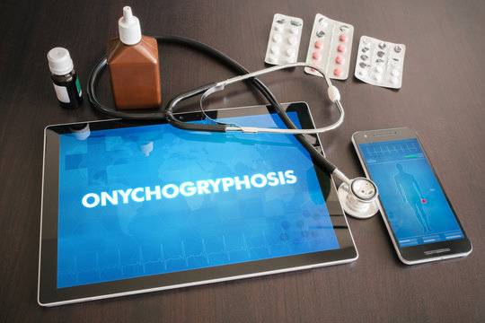 Onychogryphosis (cutaneous disease) diagnosis medical concept on tablet screen with stethoscope
