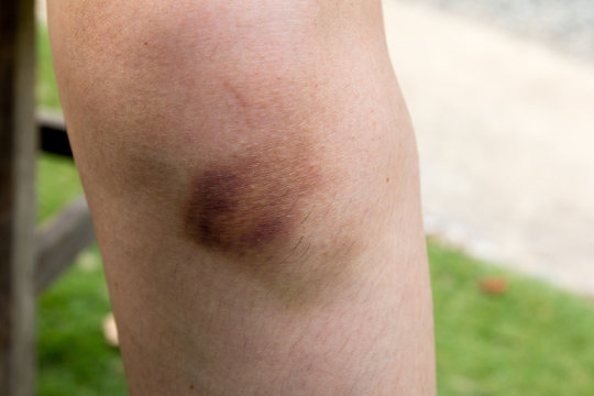 Brown Bruise On Woman Knee Background