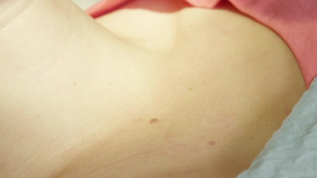 EXTREME CLOSE UP Doctor disinfecting beauty mark before the surgical removal. Dermatologist treating benign tissue on the body of young female patient & preparing skin for the cosmetic procedure