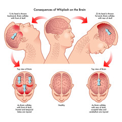 consequences of whiplash on the brain - obrazy, fototapety, plakaty