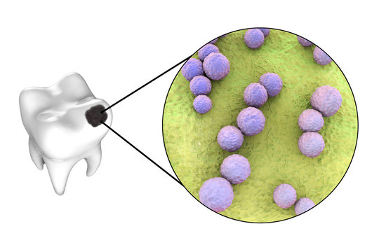 Tooth with dental caries and close-up view of microbes which cause caries Streptococcus mutans, 3D illustration