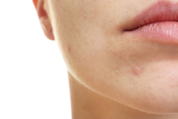 Face of beautiful young woman with problem skin, closeup