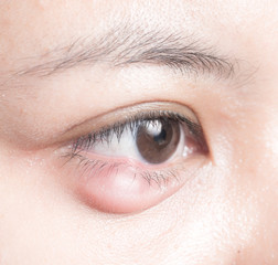 Close up of eyelid abscess (stye, hordeolum)