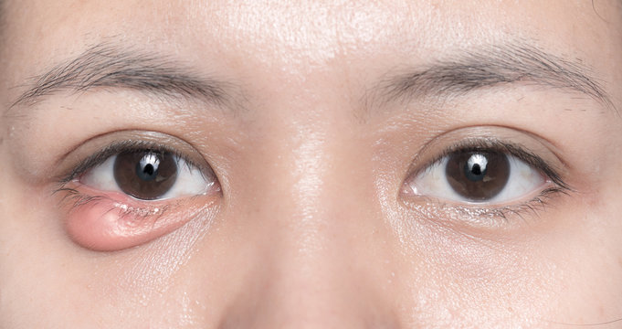 Close up of eyelid abscess (stye, hordeolum)