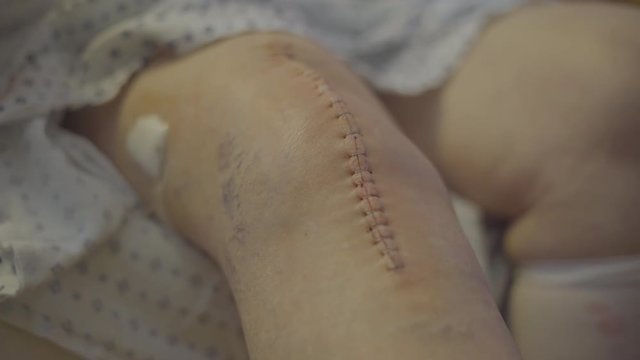 Knee replacement scar and staples