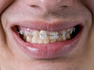 Close-up of the mouth of a teenager, who has been given brackets