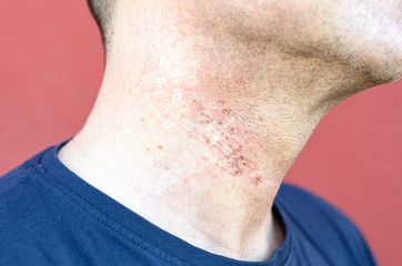 Skin irritation after cosmetic surgery