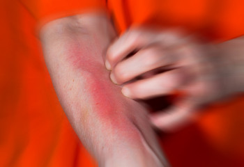 A woman has reddened skin and a strong itching
