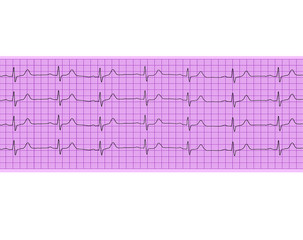 Heart analysis, electrocardiogram graph (ECG)