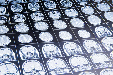 MRI of the brain. snapshot