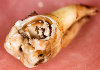 caries in the tooth. macro