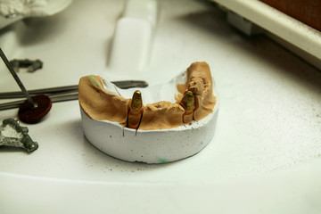 The plaster model of the jaws with tools. Dental prosthesis, dentures, prosthetics work. Dental...