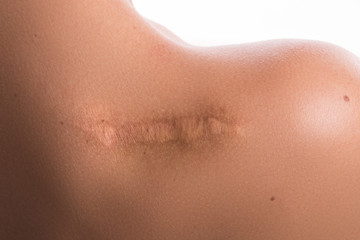 Woman with a scar on her shoulder