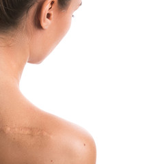 Woman with a scar on her shoulder