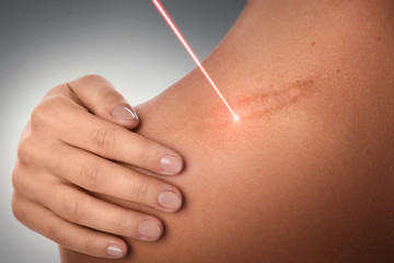 Laser scar removal treatment - obrazy, fototapety, plakaty