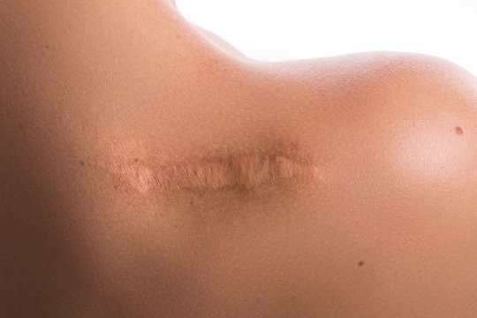 Woman with a scar on her shoulder