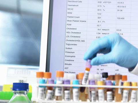 Health Check Results, Haematologist checking medical samples including blood for testing with results on the computer screen