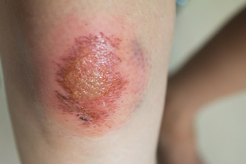 Fresh wound with lymph and blood on asian female knee background
