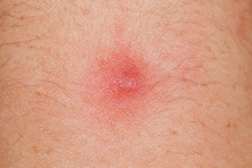 Red pimple on human skin