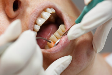 Dental laser used on a patient