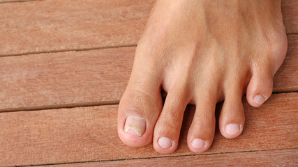 Damaged toenail, broken nail with copy space