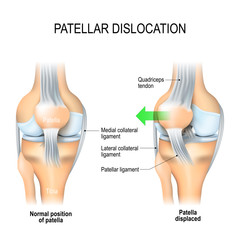 Patellar dislocation - obrazy, fototapety, plakaty