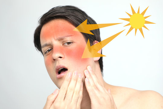young man with a bad sunburn on his face