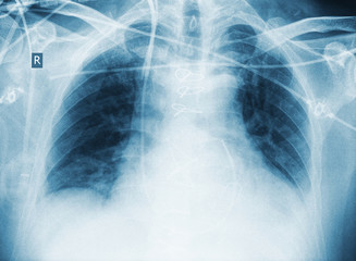 X-ray image of critically ill patient