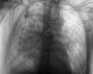 X-ray image of a patient with pneumonia