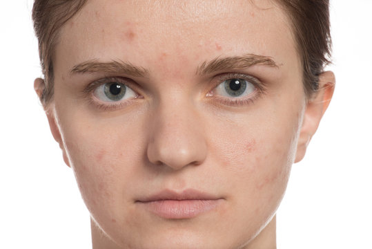 Beautiful young girl with red and white acne on her face. Before and after cream with sponge on a white background.