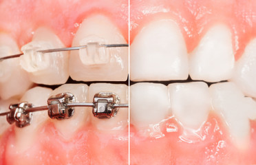 Split view of braces and tooth before them
