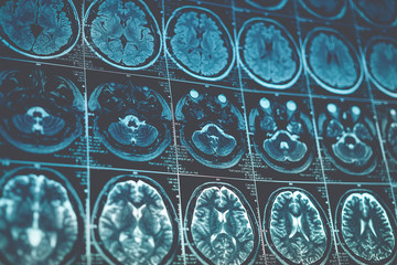 MRI or magnetic resonance image of head and brain scan. Close up view, toned