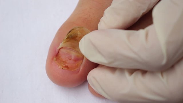 The injured nail. Nail removal. Nail loss or deformity