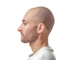 Hair loss concept. Portrait of young bald man on white background