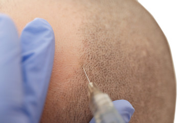 Man receiving stimulating injection for hair growth, closeup
