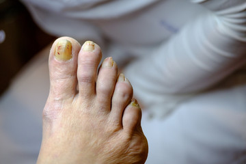 Sick unhealthy nails on the foot of a man isolated