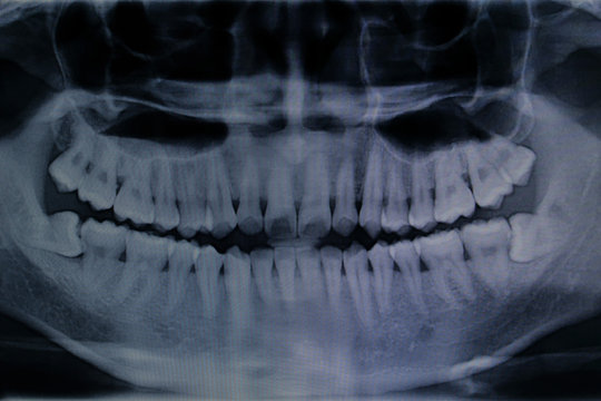 teeth x-ray for pattern and design