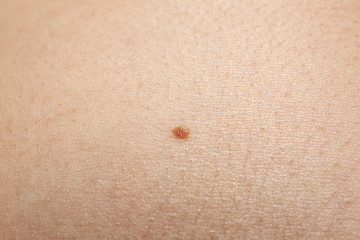 Human skin with birthmark, closeup