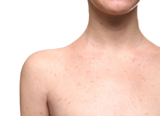 Young woman with problem skin on white background, closeup